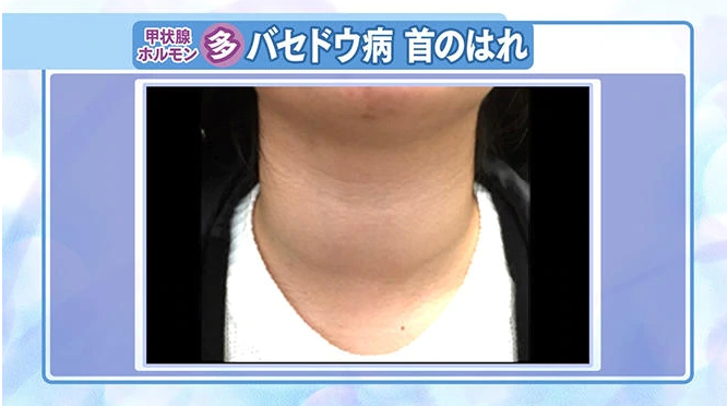 吉住 芸人 の甲状腺が病気 首の画像や噂の原因から腫れの大きさを調査
